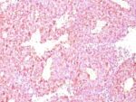 Chromogranin A(LK2H10 + PHE5), 0.2mg/mL 1 BNUB0698-0-1